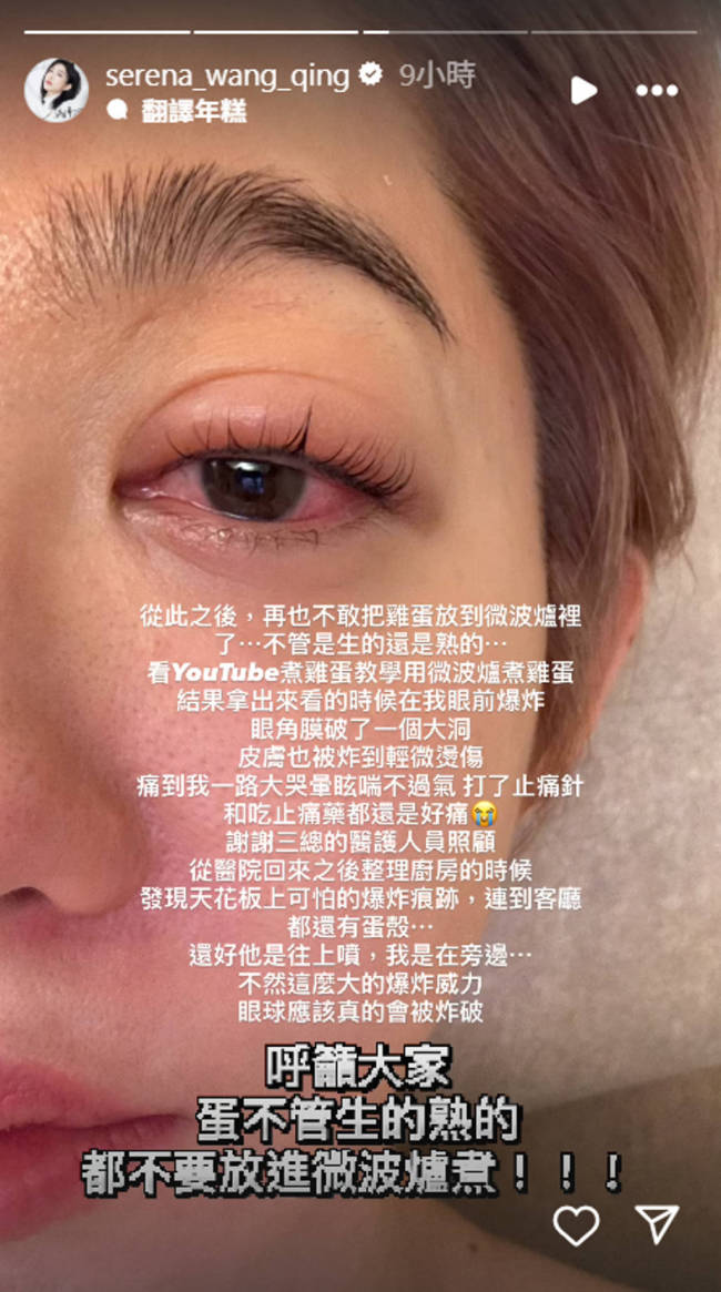 女演员微波炉煮鸡蛋被炸伤眼睛：眼角膜破了个大洞
